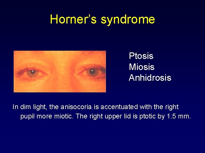 Horner’s syndrome Ptosis Miosis Anhidrosis In dim light, the anisocoria is accentuated with the