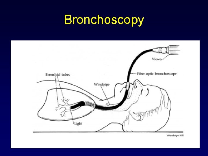 Bronchoscopy 