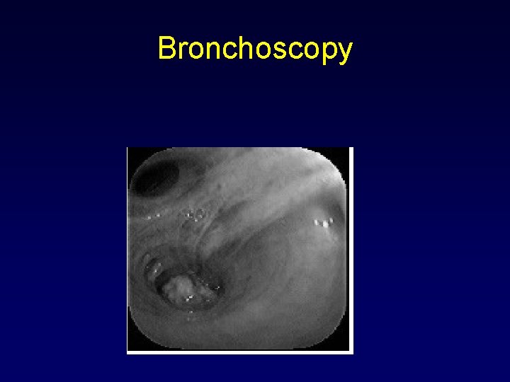 Bronchoscopy 