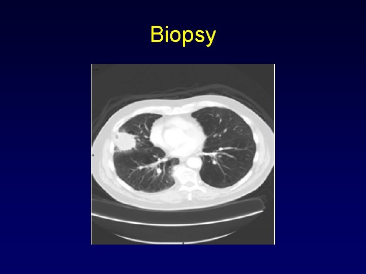 Biopsy 