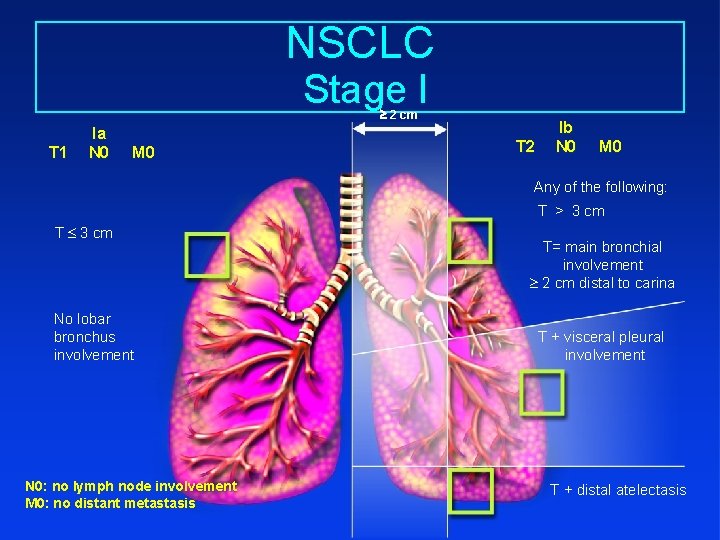 NSCLC Stage I 2 cm T 1 Ia N 0 M 0 T 2