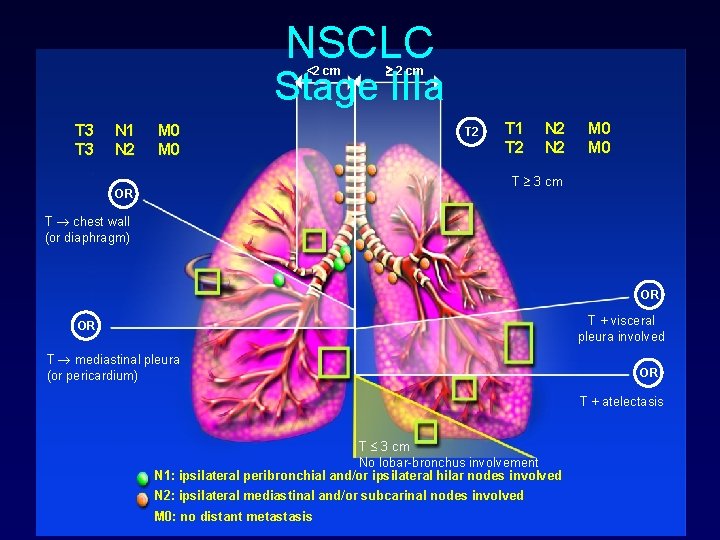 NSCLC 2 cm Stage IIIa <2 cm T 3 N 1 N 2 M