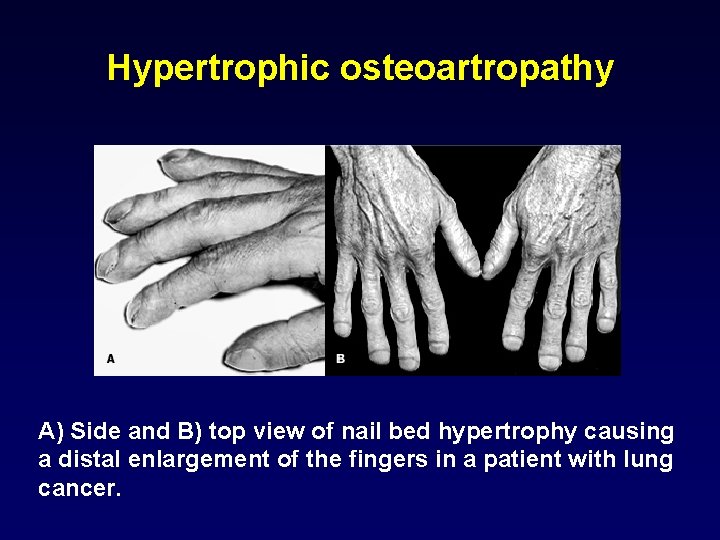 Hypertrophic osteoartropathy A) Side and B) top view of nail bed hypertrophy causing a