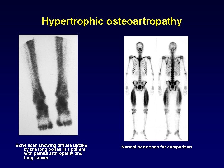 Hypertrophic osteoartropathy Bone scan showing diffuse uptake by the long bones in a patient