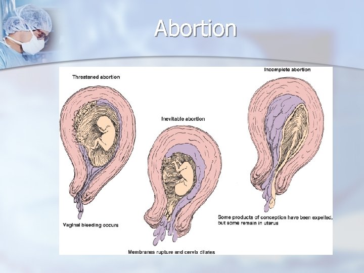 Abortion 