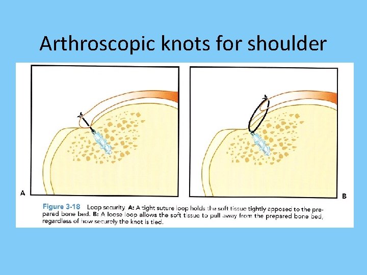 Arthroscopic knots for shoulder 