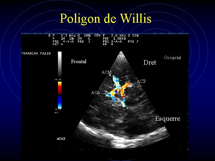 Poligon de Willis Frontal Dret Occipital ACM ACP ACA Esquerre 