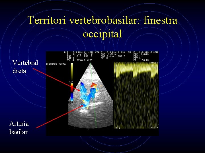 Territori vertebrobasilar: finestra occipital Vertebral dreta Arteria basilar 