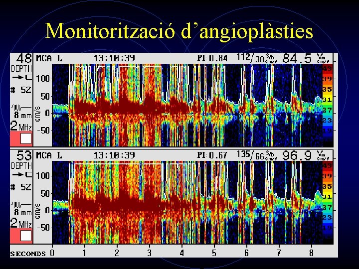 Monitorització d’angioplàsties 