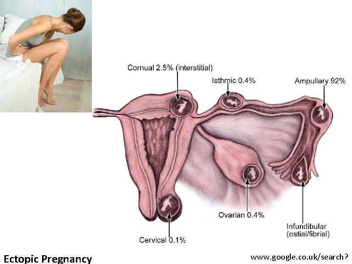 Ectopic Pregnancy www. google. co. uk/search? 