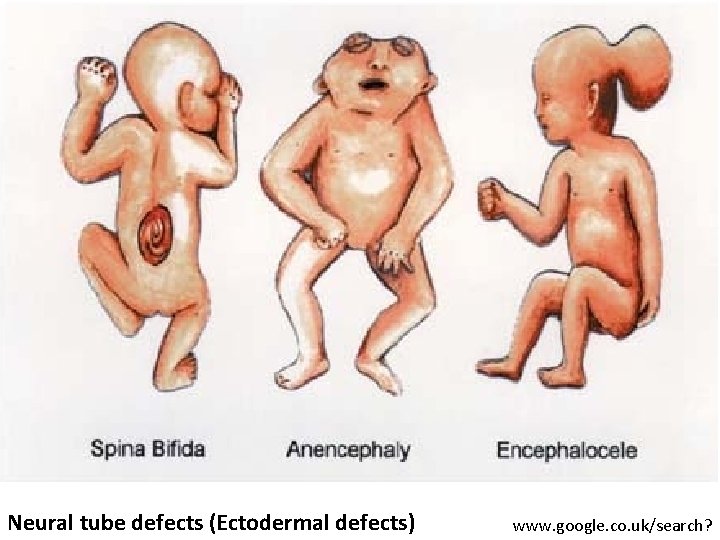 Neural tube defects (Ectodermal defects) www. google. co. uk/search? 
