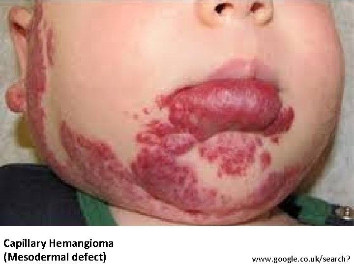 Capillary Hemangioma (Mesodermal defect) www. google. co. uk/search? 