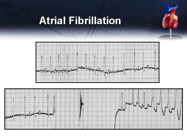 Atrial Fibrillation 