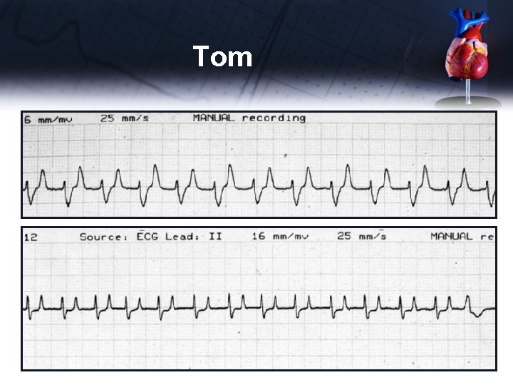 Tom • ECG 2 – 6 minutes later 