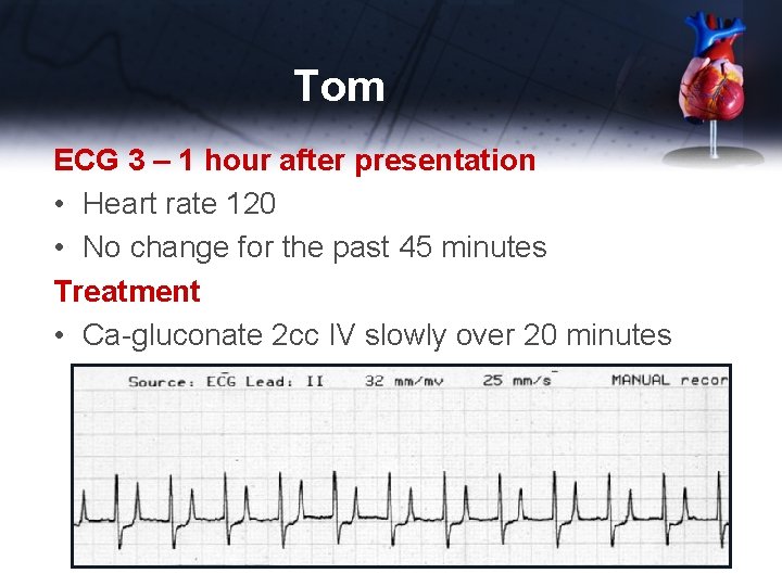 Tom ECG 3 – 1 hour after presentation • Heart rate 120 • No