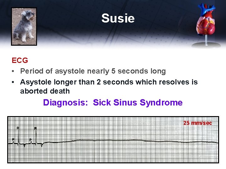 Susie ECG • Period of asystole nearly 5 seconds long • Asystole longer than