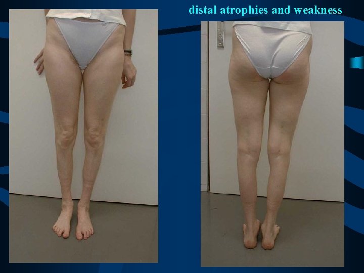 distal atrophies and weakness 