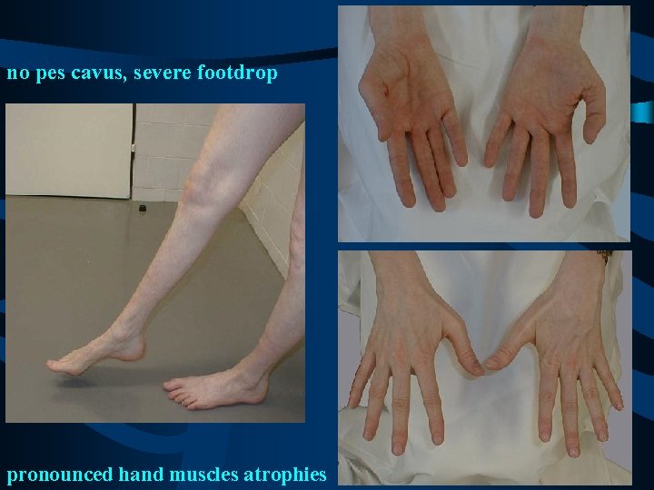 no pes cavus, severe footdrop pronounced hand muscles atrophies 