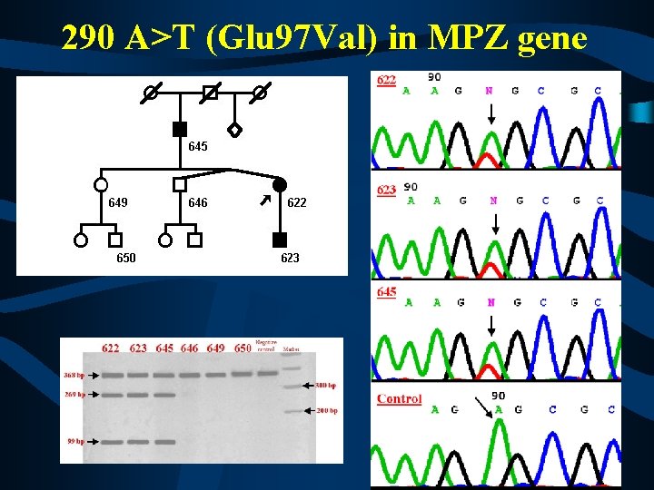 290 A>T (Glu 97 Val) in MPZ gene 