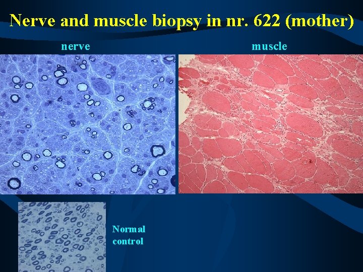 Nerve and muscle biopsy in nr. 622 (mother) nerve muscle Normal control 