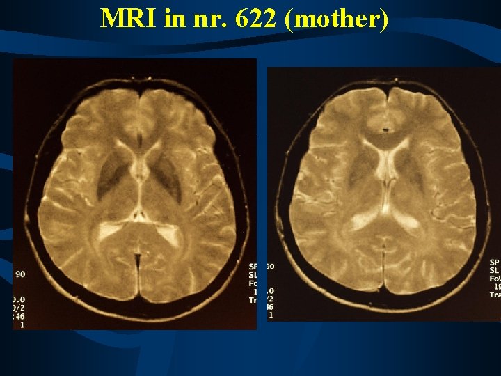 MRI in nr. 622 (mother) 