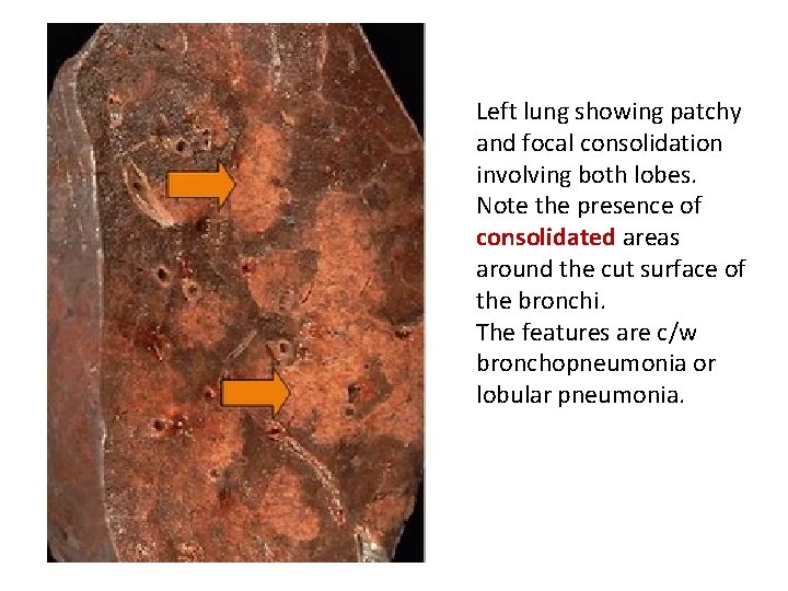 Left lung showing patchy and focal consolidation involving both lobes. Note the presence of