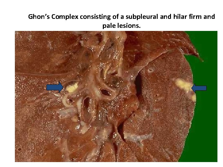 Ghon’s Complex consisting of a subpleural and hilar firm and pale lesions. 