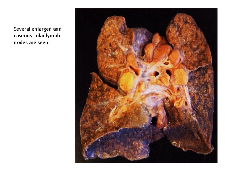 Several enlarged and caseous hilar lymph nodes are seen. 