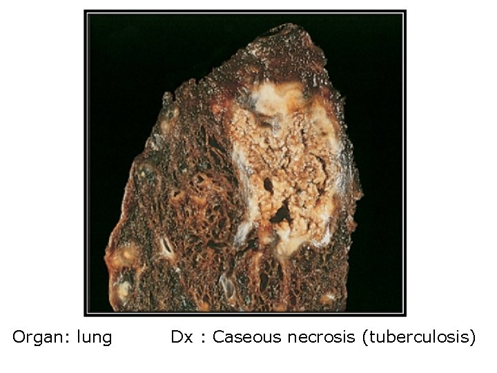 Organ: lung Dx : Caseous necrosis (tuberculosis) 