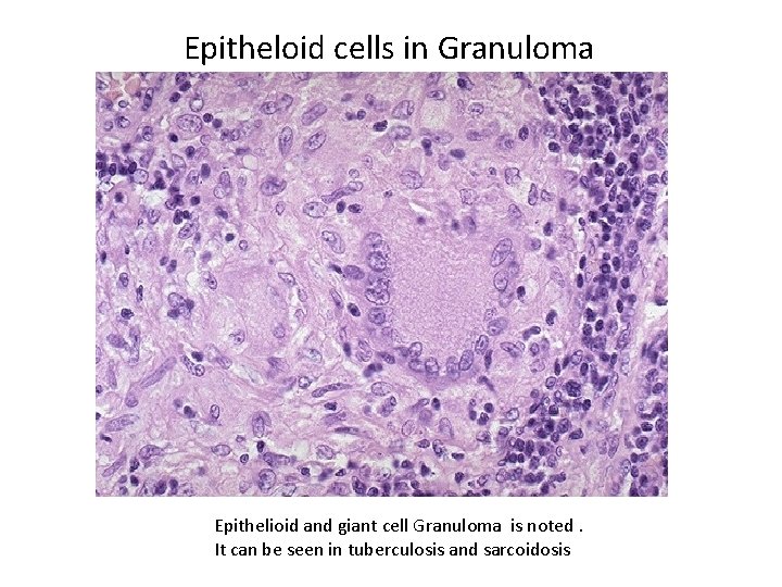 Epitheloid cells in Granuloma Epithelioid and giant cell Granuloma is noted. It can be