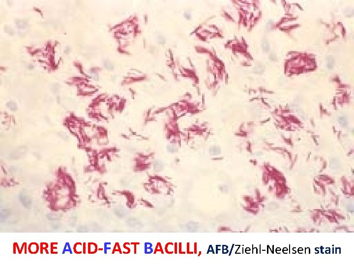 MORE ACID-FAST BACILLI, AFB/Ziehl-Neelsen stain 