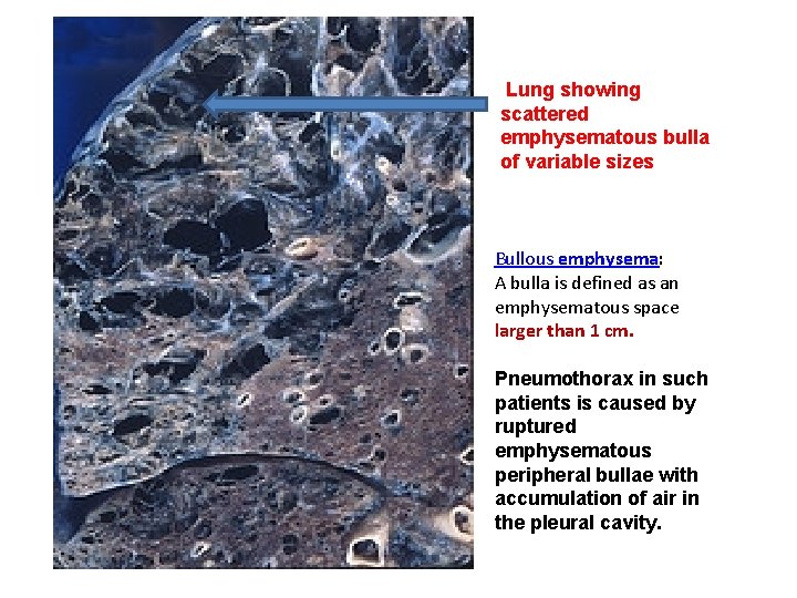 Lung showing scattered emphysematous bulla of variable sizes Bullous emphysema: A bulla is defined