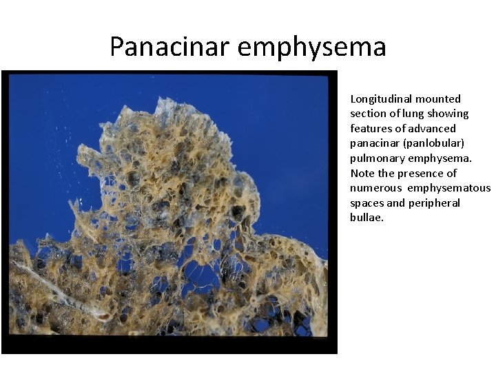 Panacinar emphysema Longitudinal mounted section of lung showing features of advanced panacinar (panlobular) pulmonary