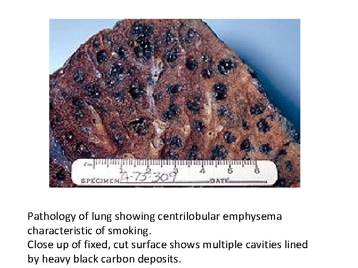 Pathology of lung showing centrilobular emphysema characteristic of smoking. Close up of fixed, cut