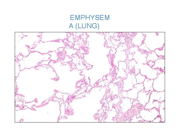 EMPHYSEM A (LUNG) 