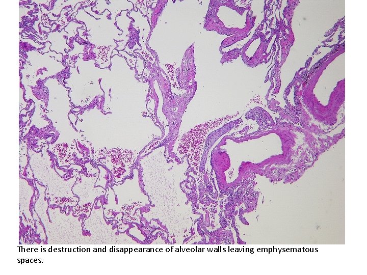 There is destruction and disappearance of alveolar walls leaving emphysematous spaces. 