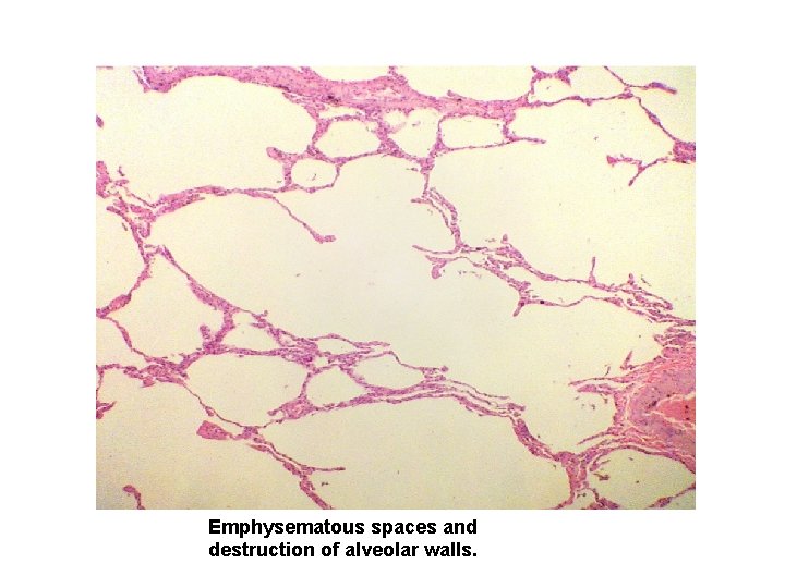 Emphysematous spaces and destruction of alveolar walls. 