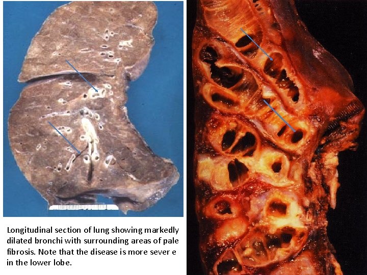 Longitudinal section of lung showing markedly dilated bronchi with surrounding areas of pale fibrosis.