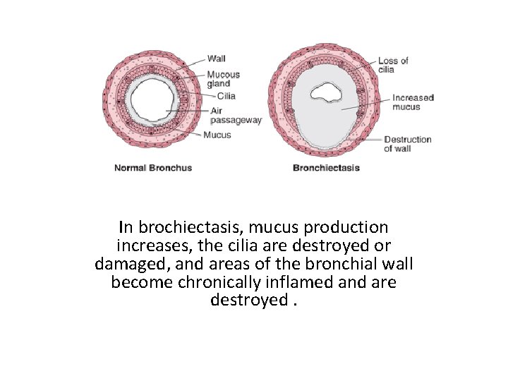 In brochiectasis, mucus production increases, the cilia are destroyed or damaged, and areas of