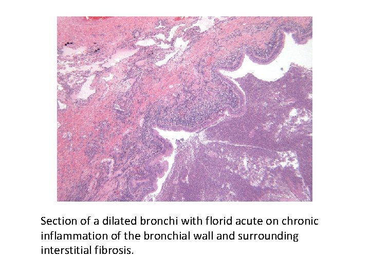 Section of a dilated bronchi with florid acute on chronic inflammation of the bronchial