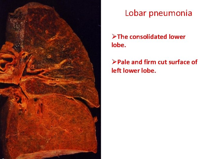 Lobar pneumonia ØThe consolidated lower lobe. ØPale and firm cut surface of left lower