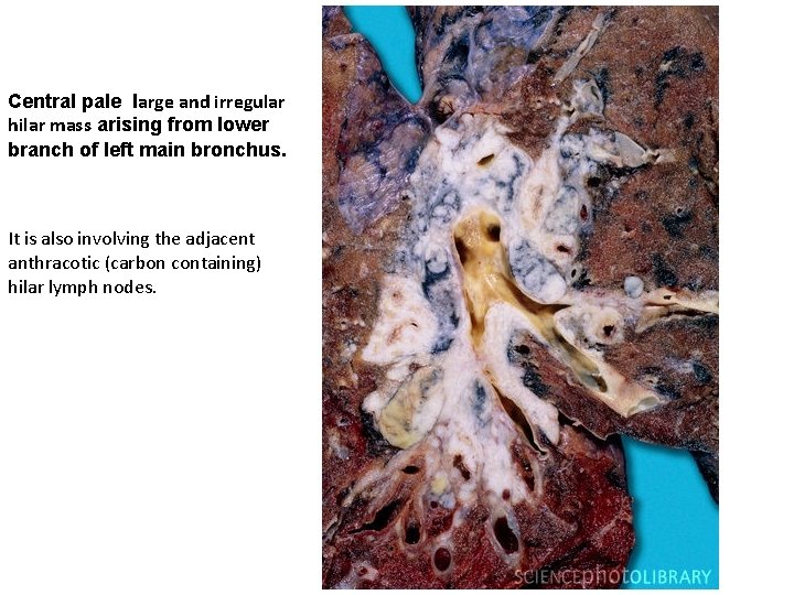 Central pale large and irregular hilar mass arising from lower branch of left main