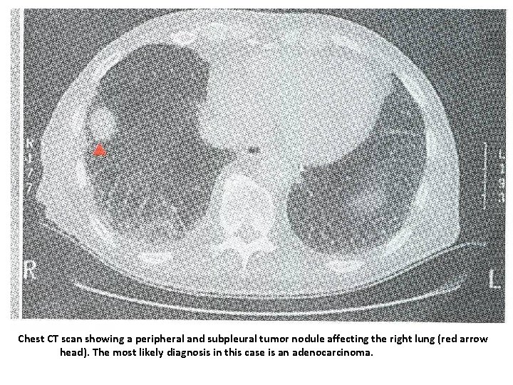 Chest CT scan showing a peripheral and subpleural tumor nodule affecting the right lung