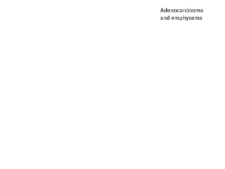 Adenocarcinoma and emphysema 