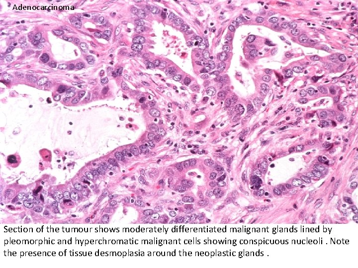 Adenocarcinoma Section of the tumour shows moderately differentiated malignant glands lined by pleomorphic and