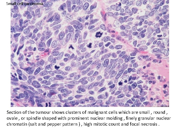 Small cell carcinoma Section of the tumour shows clusters of malignant cells which are