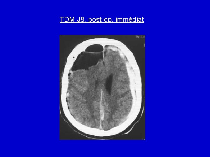 TDM J 8, post-op. immédiat 