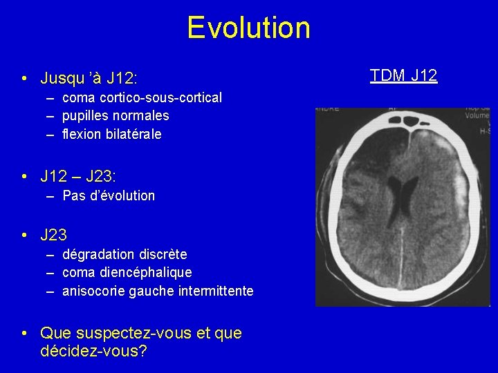 Evolution • Jusqu ’à J 12: – coma cortico-sous-cortical – pupilles normales – flexion