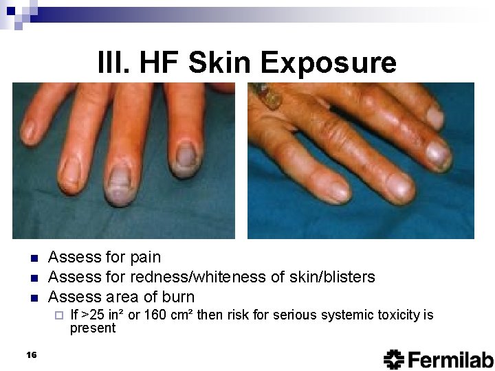 III. HF Skin Exposure n n n Assess for pain Assess for redness/whiteness of