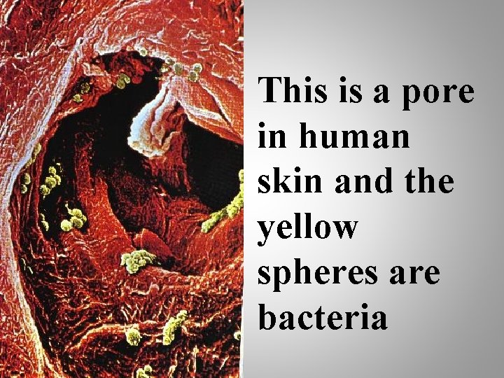This is a pore in human skin and the yellow spheres are bacteria 15